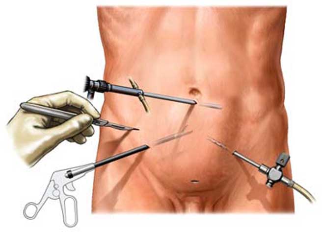 Laparoscopic Keyhole Surgery