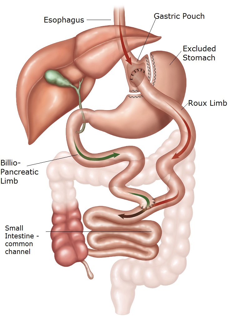 Gastric-Bypass