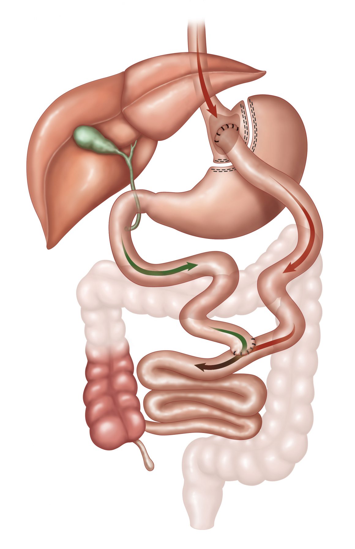 R & Υ Gastric Bypass
