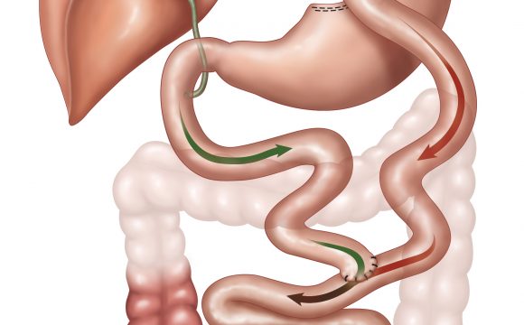 R & Υ Gastric Bypass